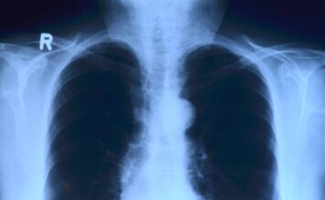 Czym jest promieniowanie rentgenowskie i jak umożliwia diagnostykę medyczną